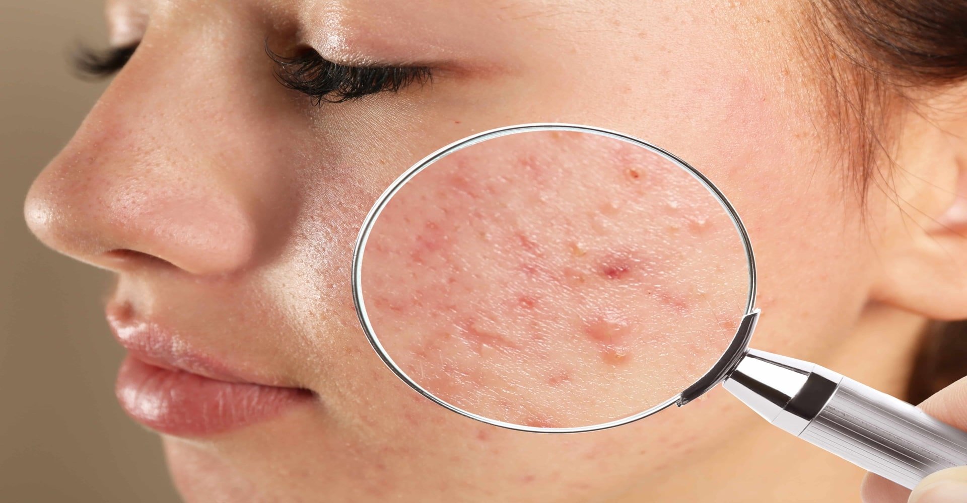 Imagem De Um Rosto Com Manchas De Acne